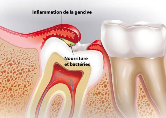 inflammation de la gencive