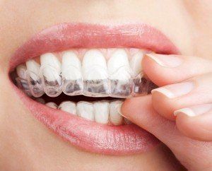 Une gouttière Invisalign