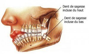 Dents de sagesse semi-incluses