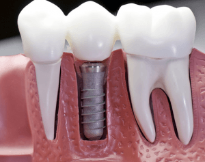 suites opératoires aux implants dentaires