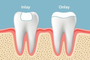 inlay onlay