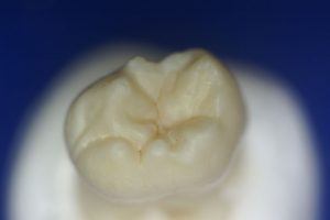 Photo de la face supérieure d'une molaire