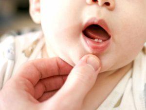 Ulcers in a child's mouth