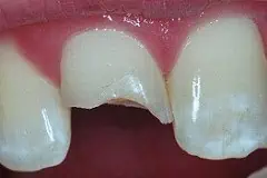 Dent cassée