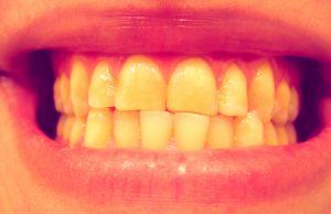 Dent qui grince photo d'un patient qui grince des dents