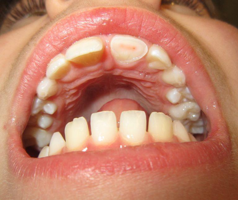 Dent cassée comment réagir en attendant le dentiste
