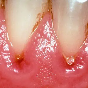 Symptôme de la parodontose