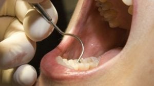 Chirurgie et déchaussement dentaire