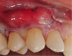 Greffe de gencive : un déchaussement dentaire traitement