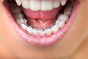 Appareil lingual Invisalign