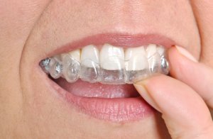 invisalign prix