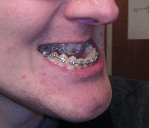 Orthodontie pour corriger menton prognathe