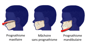 Schéma d'une mâchoire prognathe, "normale" et rétrognathe