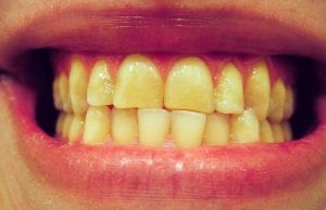 dents jaunes