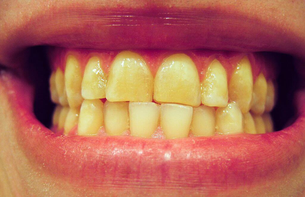 Dents jaunes notre dossier complet Solutions et causes