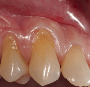 Récession gingivale