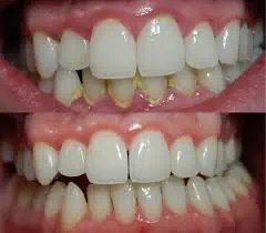 traitement gingivite pour dent qui bouge
