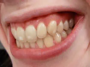 fluorose dentaire