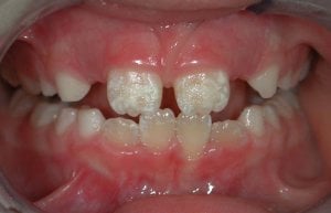 fluorose dents