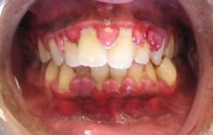 hypertrophie gingivale