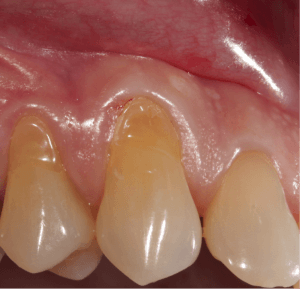récession gingivale