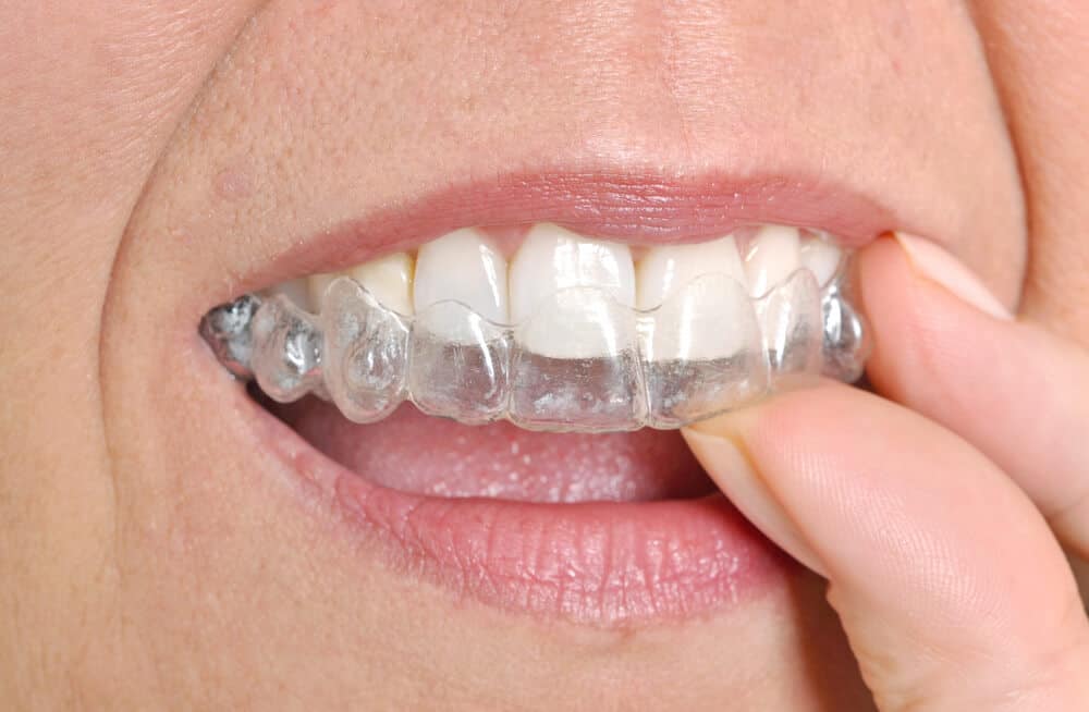 Invisalign avis sur les gouttières dentaires Invisalign