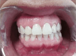 Invisalign après 