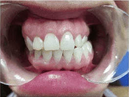Gouttière dentaire avant/après : exemple de traitement avec Invisalign