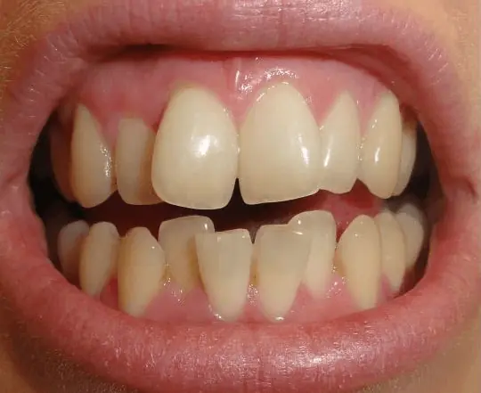 Dents malpositionnées 