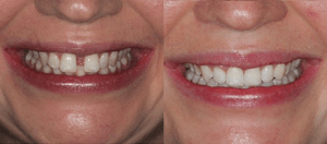 gouttières dentaires avant/après Invisalign