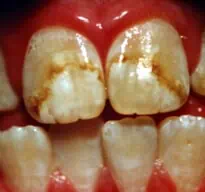 fluorose dentaire
