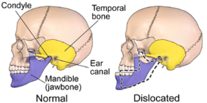 Luxation mâchoire