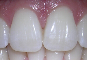 dents blanches