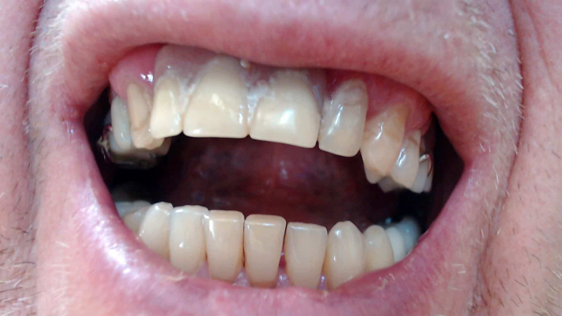 Taches blanches sur les dents causes et traitements