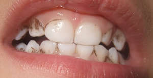 taches noires sur les dents