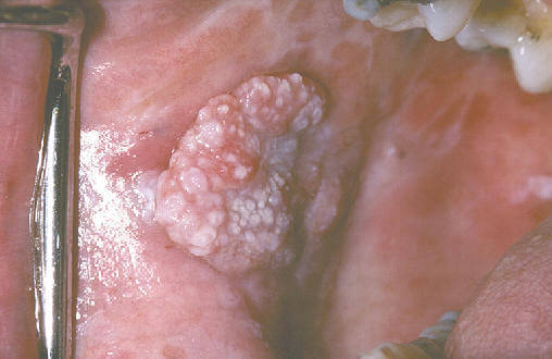 Leukoplakia