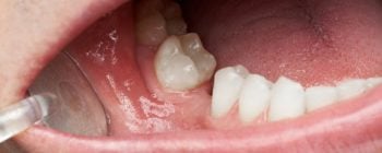 agénésie dentaire