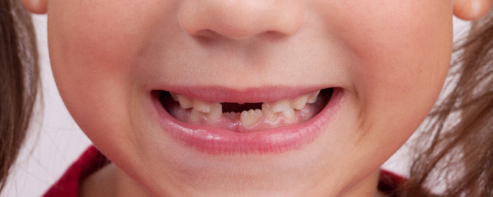 dents enfant