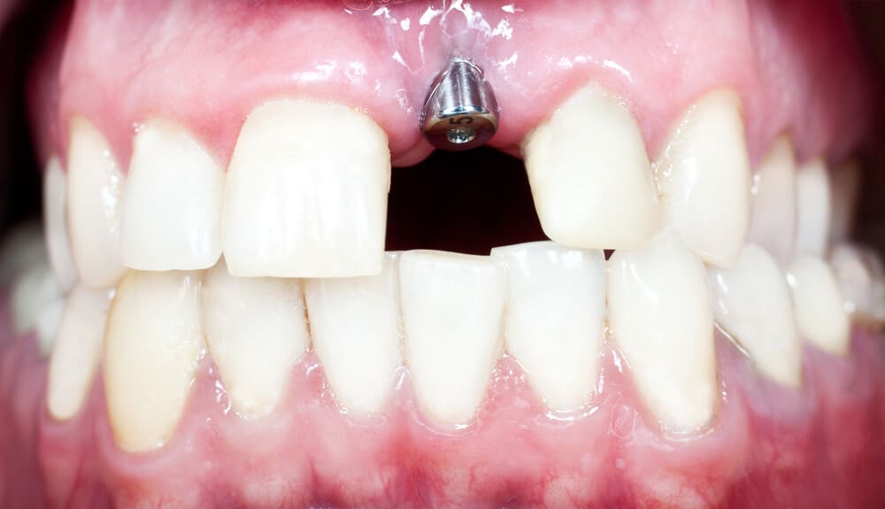 Prix implant dentaire tarifs en 2023 et astuces pour économiser Prix implant dentaire tarifs en 2023 et astuces pour économiser