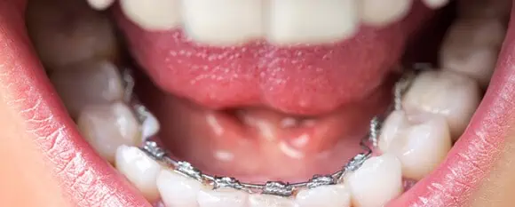 Gros plan sur un appareil lingual dans une bouche de femme