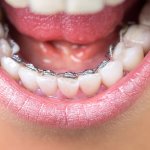 41857Malocclusion dentaire : types et solutions pour chacune