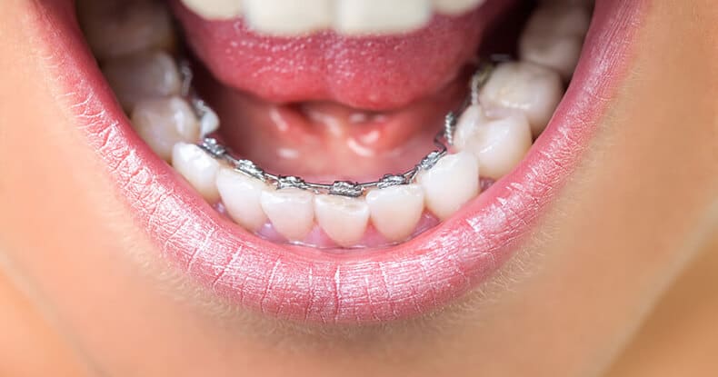Appareil dentaire lingual