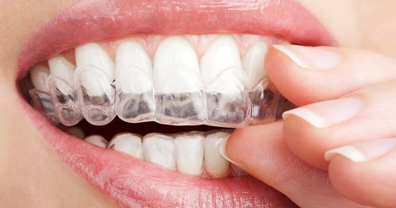 Clear braces guide
