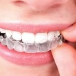Orthodontie ne rime plus avec bagues