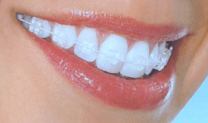 bagues dentaires en céramique