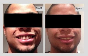 Diastème et facettes dentaires pour resserrer les dents