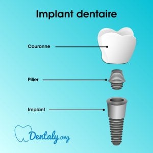 Implant dentaire