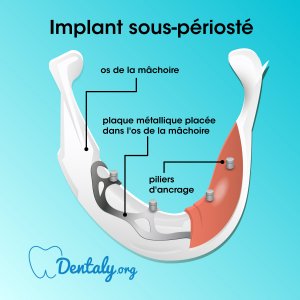 Implants sous-périosté