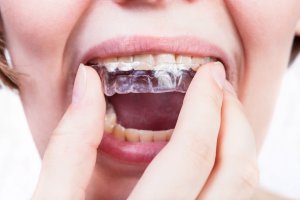 gouttières transparentes pour malocclusion