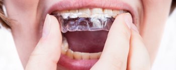 gouttières transparentes pour malocclusion